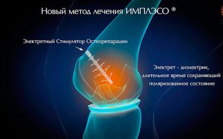 Лечение артроза — ИМПЛЭСО®