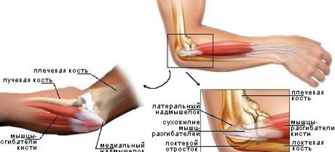 Чем лечить эпикондилит