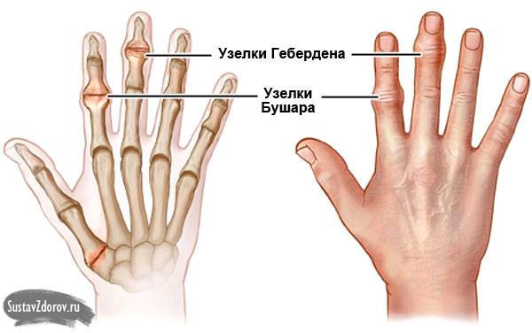 узелки Гебердена и Бушара узелки Гебердена и Бушара
