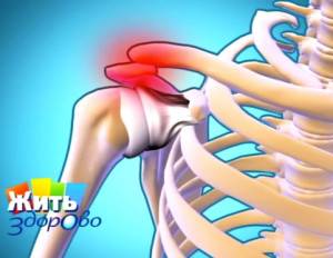 Упражнения при плечелопаточном периартрозе.