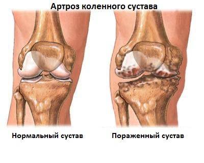 Боль коленного сустава сопровождается дискомфортом и хрустом при ходьбе