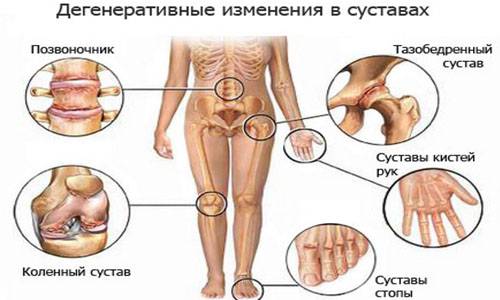 Артроз симптомы