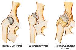 Виды дисплазии тазобедренного сустава