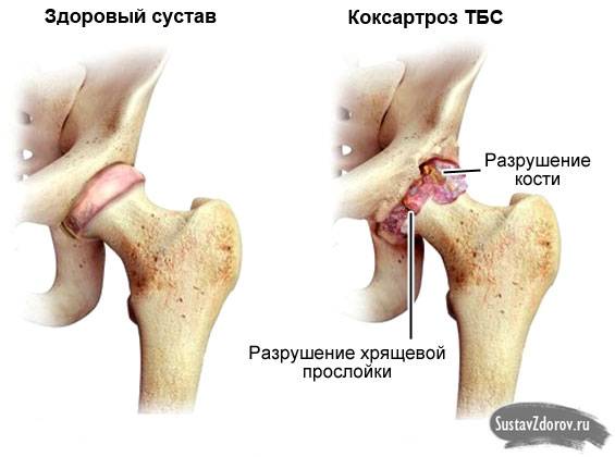 коксартроз тазобедренного сустава