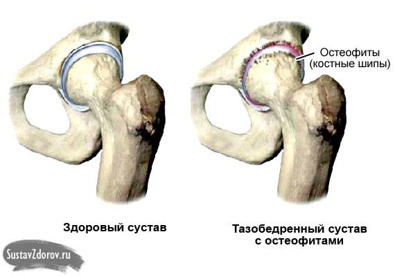 тазобедренный сустав в норме и с остеофитами