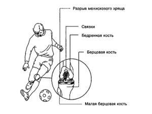 причины травм колена