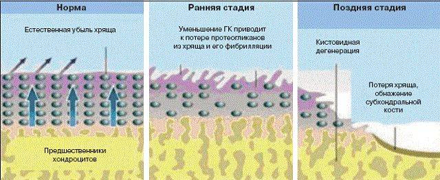 Разрушение хряща