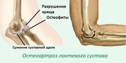 Проблема остеоартроза локтевого сустава Проблема остеоартроза локтевого сустава