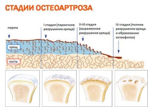 Стадии остеоартроза Стадии остеоартроза