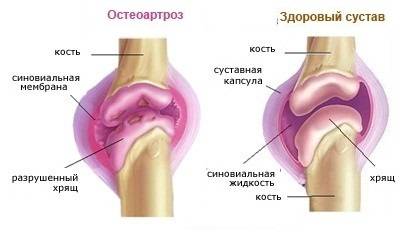 Артроз плечевого сустава