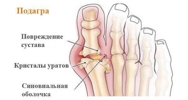 Что представляет собой заболевание