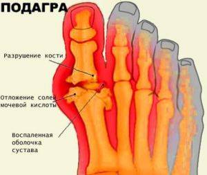 обострение подагры