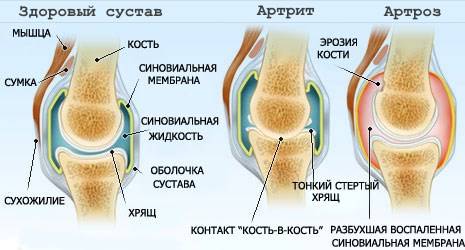 Профилактика артрита