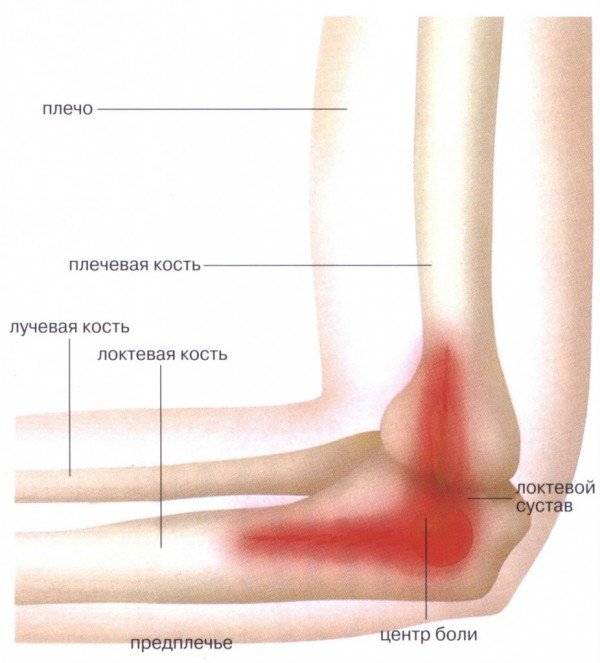 Локоть теннисиста, схема