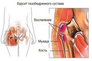 Схематичное изображение вертельного бурсита