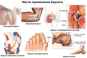 Рисунок показывает на каких суставах может сформироваться бурсит Советы о том где может развиваться бурсит