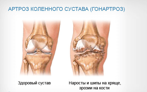 артроз-коленного-сустава