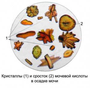Кристаллы мочевой кислоты в моче