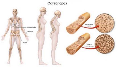 Препараты кальция для лечения остеопороза