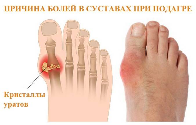 Подагра большого пальца ноги