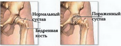 Здоровый сустав и сустав, пораженный коксартрозом Коксартрозом