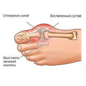 Отложение солей симптомы