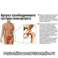 Артроз тазобедренного сустава, симптомы и лечение, гимнастика по евдокименко
