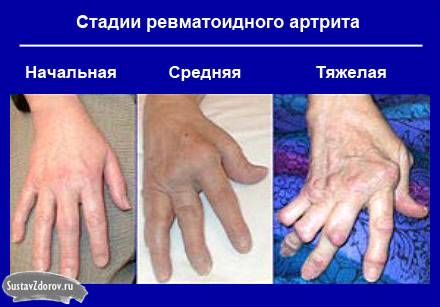 стадии ревматоидного артрита