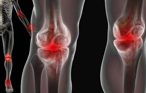 Симптомы реактивного артрита Реактивный артрит у детей симптомы