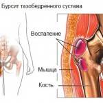 Бурсит тазобедренного сустава