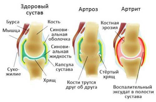 При артрите к какому врачу обращаться