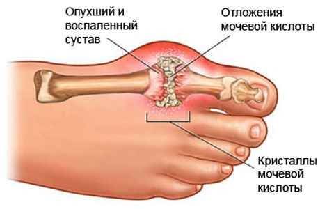 Лечение подагры народными средствами