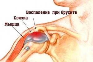 Воспаление в бурсе