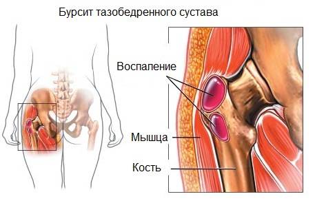 бурсит тазобедренного сустава