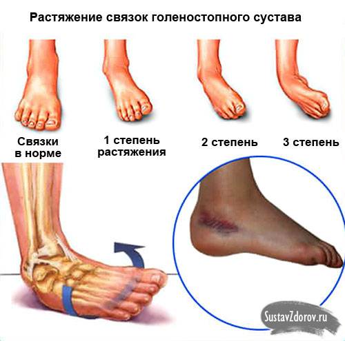 растяжение связок голеностопного сустава