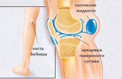 Где возникает киста