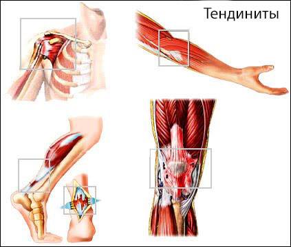 тендинит