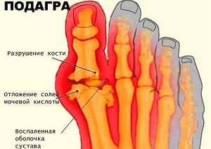 подагра что это за болезнь