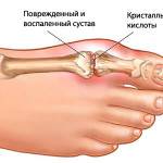 правильная диета при подагре