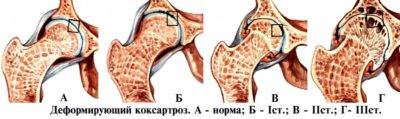 Тазобедренный сустав упражнения