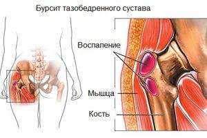 Бурсит тазобедренного сустава