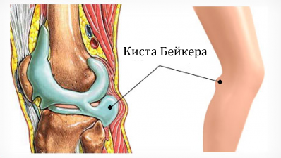 киста Бейкера киста Бейкера