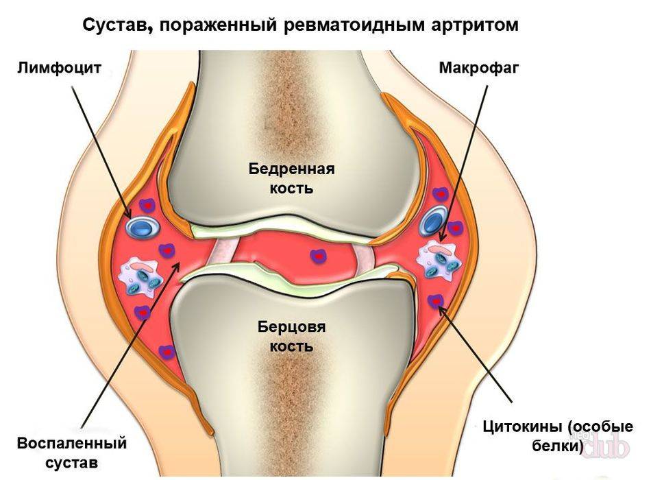 Ревматоидный артрит