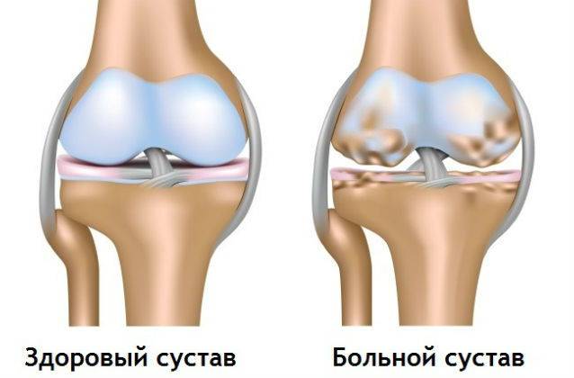 Сустав при гоноартрозе