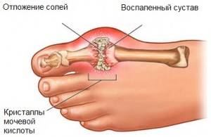 Чеснок и подагра