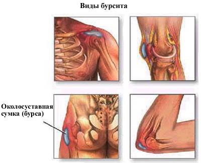 Опухоль локтя Опухоль локтя
