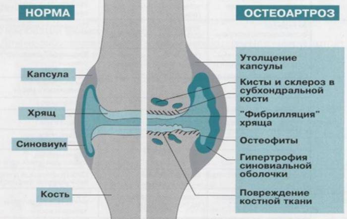 Первичный остеоартроз Сравнение нормального сустава и пораженного остеоартрозом