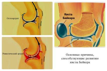 Киста Бейкера часто связана с патологиями сустава при артрозе