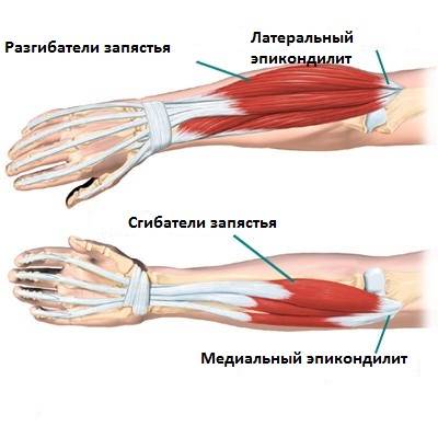 Эпикондилит Эпикондилит