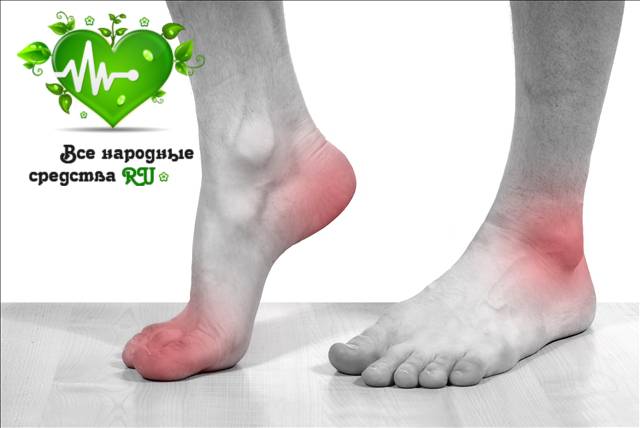 podagra-prichiny-simptomy-lechenie-2